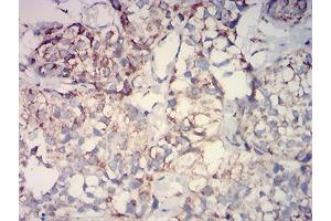 Immunohistochemical analysis of paraffin-embedded bladder cancer tissues using IDH2 mouse mAb with DAB staining. (IDH2 antibody  (AA 1-143))