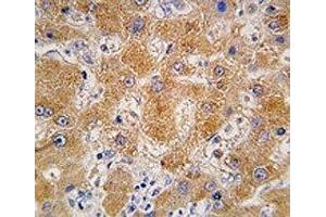 IHC analysis of FFPE human hepatocarcinoma tissue stained with APOA4 antibody (APOA4 antibody  (AA 49-79))