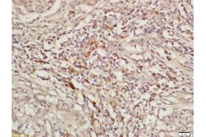 Formalin-fixed and paraffin embedded laryngeal cancer labeled with Rabbit Anti-KIF11 Polyclonal Antibody, Unconjugated  at 1:200 followed by conjugation to the secondary antibody and DAB staining (K11 (AA 351-450) antibody)