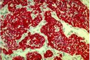 Renal cell carcinoma (MAb 2A4, cytokeratin 8, 18, 19) (Keratin 8/18/19 antibody)