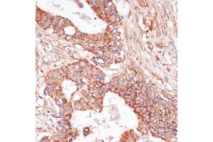 Immunohistochemistry of paraffin-embedded human colon carcinoma using MEK3 antibody (ABIN6130544, ABIN6143484, ABIN6143485 and ABIN6223650) at dilution of 1:100 (40x lens). (MAP2K3 antibody  (AA 1-170))