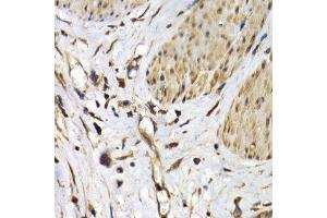 Immunohistochemistry of paraffin-embedded human stomach cancer using ISG15 antibody at dilution of 1:200 (400x lens). (ISG15 antibody)