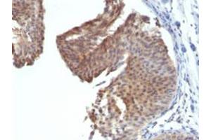 Immunohistochemical staining (Formalin-fixed paraffin-embedded sections) of human bladder carcinoma with KRT6 monoclonal antibody, clone KRT6/1702 . (KRT6A antibody)