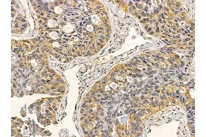Aurora A Mouse Monoclonal Antibody at 1/100 staining human lung cancer and adjacent non-tumor tissue by IHC-P.