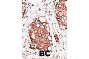 Formalin-fixed and paraffin-embedded human cancer tissue reacted with the HPCAL1 polyclonal antibody  , which was peroxidase-conjugated to the secondary antibody, followed by AEC staining. (HPCAL1 antibody  (N-Term))