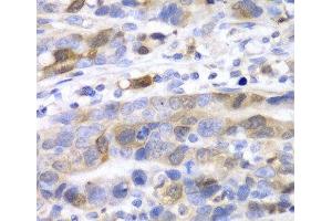 Immunohistochemistry of paraffin-embedded Human gastric cancer using UBE2C Polyclonal Antibody at dilution of 1:100 (40x lens). (UBE2C antibody)