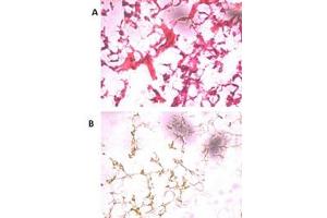 HE staining of frozen human ovarian cancer tissue reacted with the primary antibody at a 1:250 dilution. (UCHL5 antibody  (N-Term))