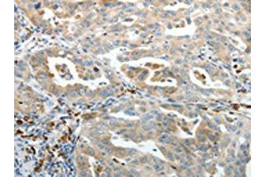 The image on the left is immunohistochemistry of paraffin-embedded Human ovarian cancer tissue using (PTEN Antibody) at dilution 1/20, on the right is treated with synthetic peptide.