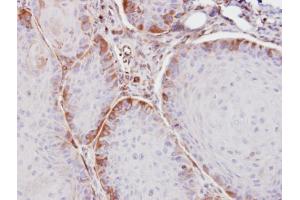 IHC-P Image Immunohistochemical analysis of paraffin-embedded Cal27 xenograft, using ASS1, antibody at 1:100 dilution. (ASS1 antibody)