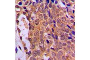 Immunohistochemical analysis of FOXO4 staining in human breast cancer formalin fixed paraffin embedded tissue section. (FOXO4 antibody  (Center))