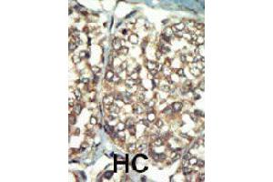 Formalin-fixed and paraffin-embedded human hepatocellular carcinoma tissue reacted with PI4K2B polyclonal antibody  , which was peroxidase-conjugated to the secondary antibody, followed by AEC staining. (PI4K2B antibody  (C-Term))