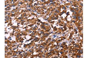 The image on the left is immunohistochemistry of paraffin-embedded Human thyroid cancer tissue using ABIN7129993(KIR2DL3/KIR2DL1/KIR2DL4/KIR2DS4 Antibody) at dilution 1/30, on the right is treated with fusion protein. (KIR2DL3/KIR2DL1/KIR2DL4/KIR2DS4 antibody)