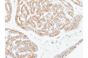 IHC-P Image Immunohistochemical analysis of paraffin-embedded human breast cancer, using ATF2, antibody at 1:250 dilution. (ATF2 antibody  (C-Term))