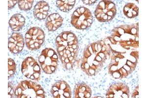 Formalin-fixed, paraffin-embedded human colon carcinoma stained with EpCAM Recombinant Rabbit Monoclonal Antibody (EGP40/1555R). (Recombinant EpCAM antibody  (N-Term))