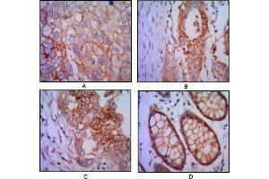 Immunohistochemical analysis of paraffin-embedded human lung cancer (A), colon cancer (B), breast cancer (C) and rectal cancer(D), using EPCAM mouse mAb with DAB staining.