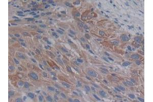 IHC-P analysis of Human Lung cancer Tissue, with DAB staining. (PCSK9 antibody  (AA 156-461))