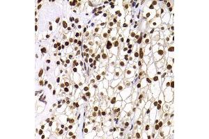 Immunohistochemistry of paraffin-embedded human kidney cancer using PHIP antibody (ABIN5974339) at dilution of 1/100 (40x lens).