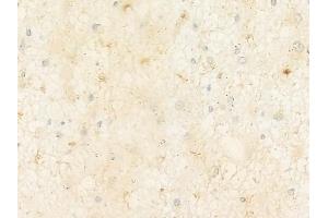 ABIN6262295 and ABIN6272846 at 1/100 staining human astrocytoma by IHC-P.