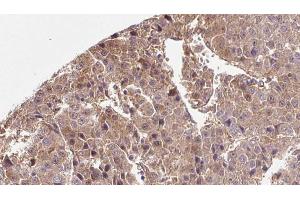 ABIN6266554 at 1/100 staining Human liver cancer tissue by IHC-P. (SLC2A3 antibody  (C-Term))