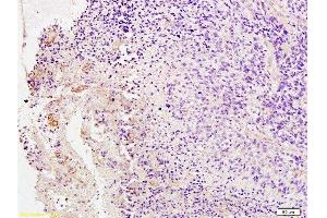 Formalin-fixed and paraffin embedded Human brain glioma labeled with Anti-PDGFRB Polyclonal Antibody, Unconjugated  at 1:200 followed by conjugation to the secondary antibody and DAB staining