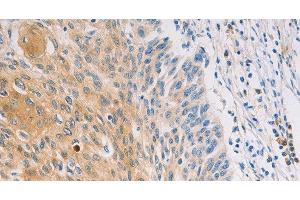 Immunohistochemistry of paraffin-embedded Human breast cancer tissue using MUC5B Polyclonal Antibody at dilution 1:30 (MUC5B antibody)