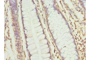 Immunohistochemistry of paraffin-embedded human colon cancer using ABIN7154797 at dilution of 1:100 (CLCN7 antibody  (AA 626-805))