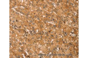 Immunohistochemistry of Human liver cancer using SNAP29 Polyclonal Antibody at dilution of 1:45