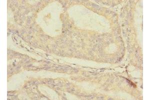 Immunohistochemistry of paraffin-embedded human endometrial cancer using ABIN7176671 at dilution of 1:100 (SLC3A1 antibody  (AA 328-507))