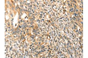 The image on the left is immunohistochemistry of paraffin-embedded Human breast cancer tissue using ABIN7192932(TRPV3 Antibody) at dilution 1/30, on the right is treated with synthetic peptide. (TRPV3 antibody)
