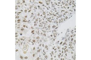 Immunohistochemistry of paraffin-embedded human lung cancer using FAF1 antibody (ABIN5975642) (40x lens). (FAF1 antibody)