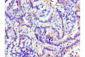Immunohistochemistry of paraffin-embedded human lung cancer using ABIN7176599 at dilution of 1:100 (TRIM27 antibody  (AA 214-513))