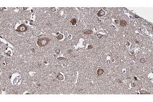 ABIN6277226 at 1/100 staining Human brain cancer tissue by IHC-P.