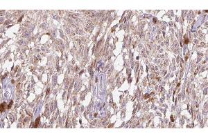 ABIN6276521 at 1/100 staining Human Melanoma tissue by IHC-P. (IL-18 antibody  (Internal Region))
