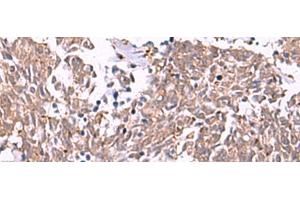 Immunohistochemistry of paraffin-embedded Human lung cancer tissue using IRX2 Polyclonal Antibody at dilution of 1:45(x200) (IRX2 antibody)