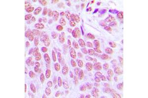 Immunohistochemical analysis of ITPKC staining in human breast cancer formalin fixed paraffin embedded tissue section.