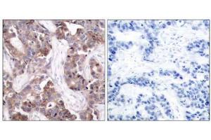 Immunohistochemical analysis of paraffin-embedded human breast carcinoma tissue using Stathmin 1 (phospho-Ser24) antibody (E011224). (Stathmin 1 antibody  (pSer24))