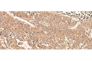 Immunohistochemistry of paraffin-embedded Human liver cancer tissue using LDAH Polyclonal Antibody at dilution of 1:55(x200) (LDAH/C2orf43 antibody)