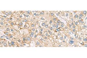 Immunohistochemistry of paraffin-embedded Human liver cancer tissue using HMOX1 Polyclonal Antibody at dilution of 1:70(x200) (HMOX1 antibody)