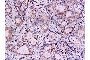 Formalin-fixed and paraffin embedded human colon carcinoma labeled with Anti-Survivin Polyclonal Antibody, Unconjugated (ABIN670911) at 1:200, followed by conjugation to the secondary antibody and DAB staining (Survivin antibody  (AA 85-142))