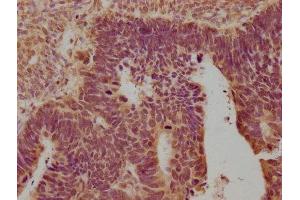 IHC image of ABIN7139899 diluted at 1:100 and staining in paraffin-embedded human ovarian cancer performed on a Leica BondTM system. (OPRK1 antibody  (AA 31-50))
