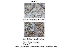 Researcher: Department of Pathology, Hospital de Carabineros de Chile, Santiago, ChileApplication: IHCSpecies+tissue/cell type: Control-Human small intestine, Sample-human colorectal cancer Primary Antibody dilution: 1:100Secondary Antibody: Biotinylated pig anti-rabbit+streptavidin-HRP (MMP3 antibody  (Middle Region))