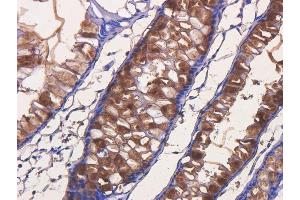 Immunohistochemical staining of human rectal carcinoma using anti-TAG72 antibody  Formalin fixed human rectal carcinoma slices were were stained with  at 5 µg/ml. (Recombinant TAG-72 (Satumomab Biosimilar) antibody)