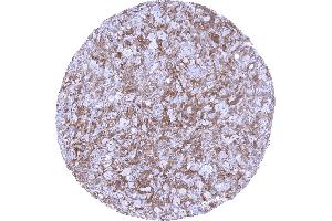 Hodgkins lymphoma containing a dense population of factor XIIIa positive cells (F13A1 antibody  (AA 46-181))