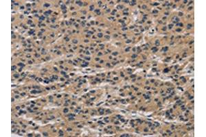 The image on the left is immunohistochemistry of paraffin-embedded Human liver cancer tissue using ABIN7190293(CLEC2A Antibody) at dilution 1/20, on the right is treated with synthetic peptide. (CLEC2A antibody)
