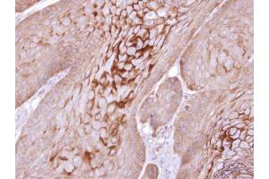 IHC-P Image Immunohistochemical analysis of paraffin-embedded Cal27 xenograft, using KLK11, antibody at 1:100 dilution. (Kallikrein 11 antibody)