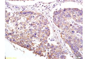 Formalin-fixed and paraffin embedded human lung carcinoma labeled with Anti-XAGE2 Polyclonal Antibody, Unconjugated (ABIN721750) at 1:200 followed by conjugation to the secondary antibody and DAB staining.