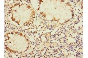 Immunohistochemistry of paraffin-embedded human colon cancer using ABIN7150754 at dilution of 1:100 (DUSP16 antibody  (AA 416-665))