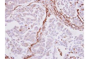 IHC-P Image alpha smooth muscle Actin antibody detects alpha smooth muscle Actin protein at cytoplasm on human liver carcinoma stroma by immunohistochemical analysis. (Smooth Muscle Actin antibody  (N-Term))