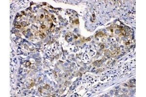 IHC testing of FFPE human esophageal squamous cancer with Cytokeratin 14 antibody at 1ug/ml. (KRT14 antibody  (AA 446-472))