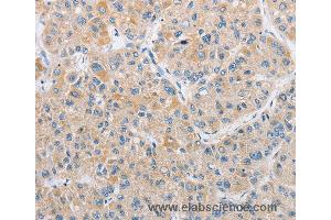 Immunohistochemistry of Human thyroid cancer using ARHGEF9 Polyclonal Antibody at dilution of 1:50